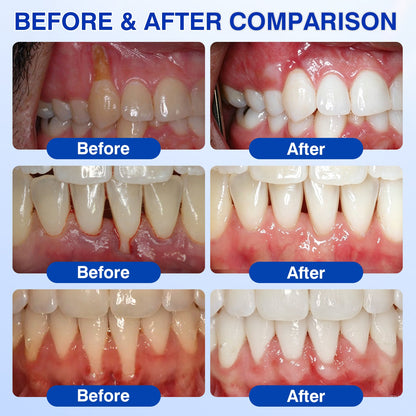 🇺🇸🏅🦷🛡️Natravor® GumRevive Periodontal Repair Gel