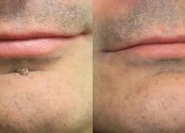 NATRAVOR® 2-in-1 Microneedle & Hydrocolloid Patch🍀| Removes Raised Moles, Acne, Flat Warts & Skin Tags | Helps Improve Wrinkles, Scars & Blemishes | Invisible Patches for Face & Body